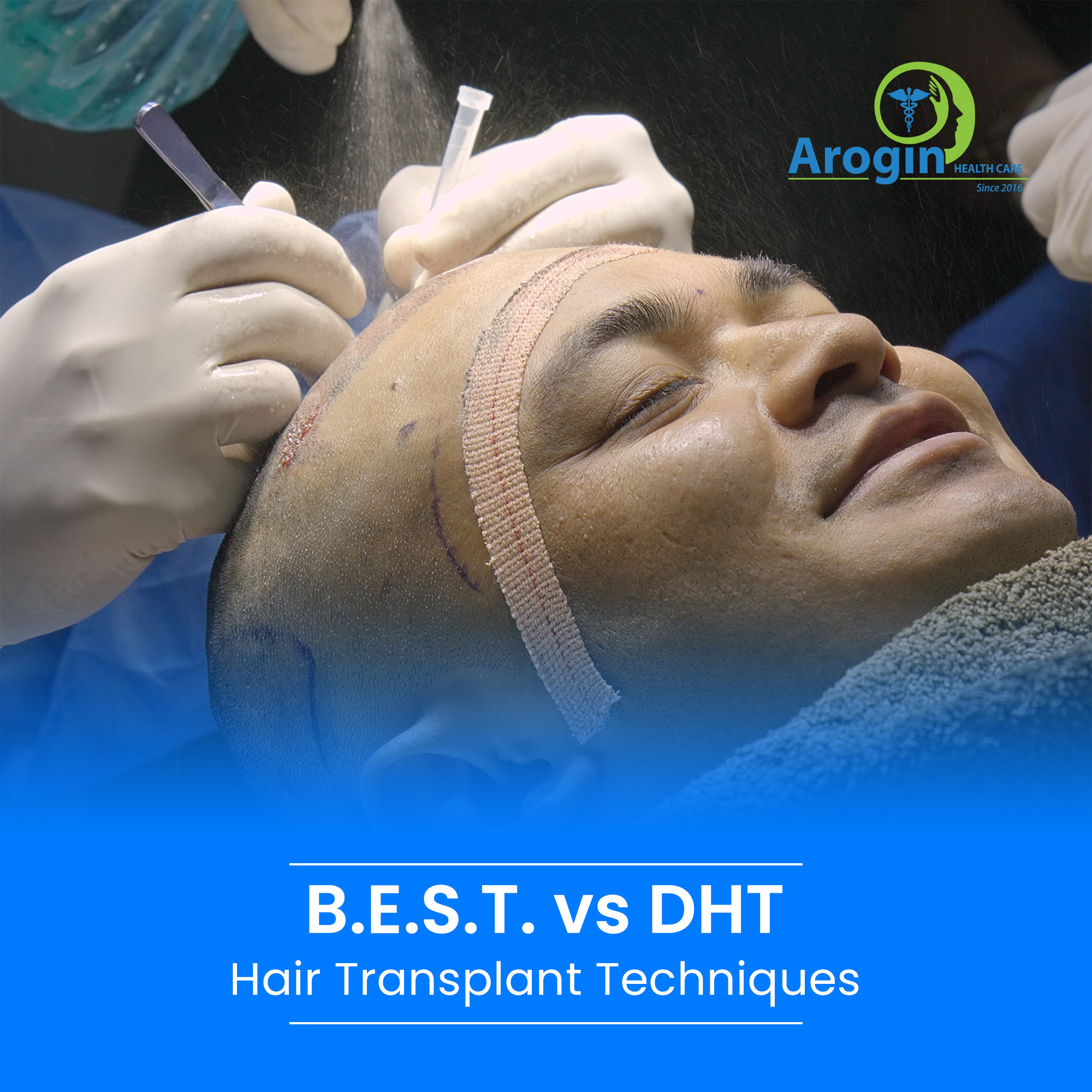 B.E.S.T. vs DHT Hair Transplant Which Gives Better Results?